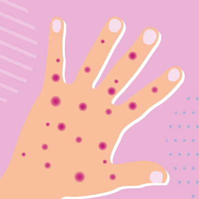 Doença infecciosa PCR em tempo real Monkeypox Test Kit MPXV CE registrado 1 teste/caixa